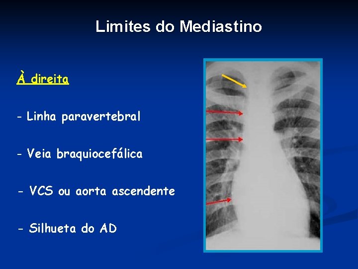Limites do Mediastino À direita - Linha paravertebral - Veia braquiocefálica - VCS ou
