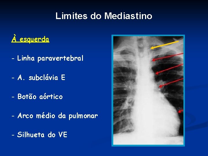 Limites do Mediastino À esquerda - Linha paravertebral - A. subclávia E - Botão