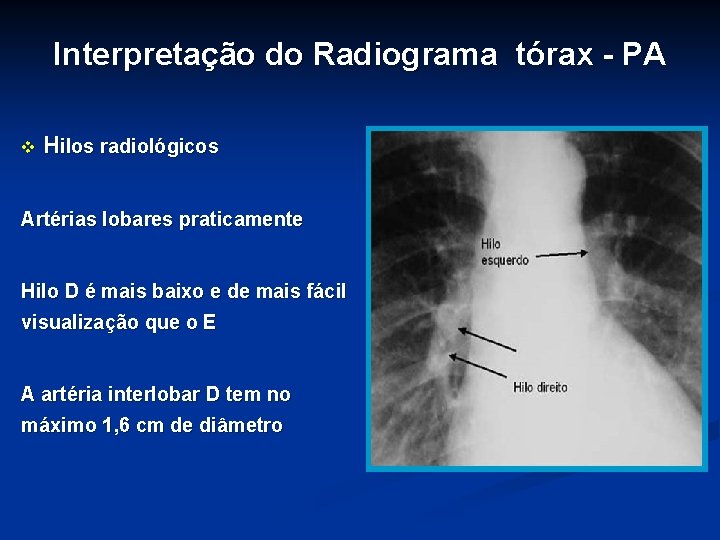 Interpretação do Radiograma tórax - PA v Hilos radiológicos Artérias lobares praticamente Hilo D