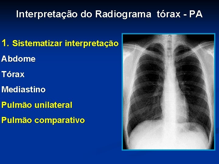 Interpretação do Radiograma tórax - PA 1. Sistematizar interpretação Abdome Tórax Mediastino Pulmão unilateral