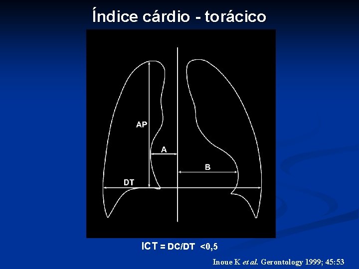 Índice cárdio - torácico ICT = DC/DT <0, 5 Inoue K et al. Gerontology