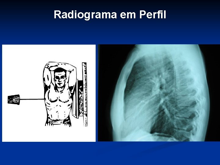 Radiograma em Perfil 