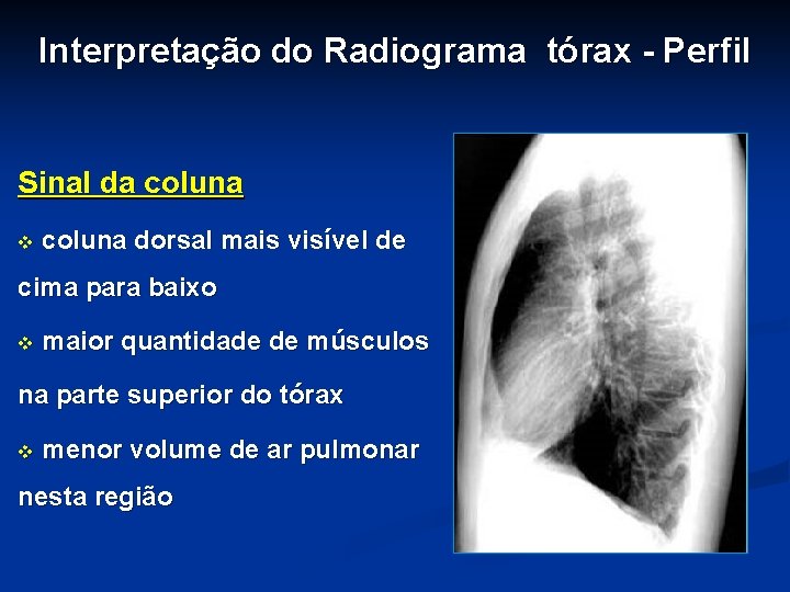 Interpretação do Radiograma tórax - Perfil Sinal da coluna v coluna dorsal mais visível