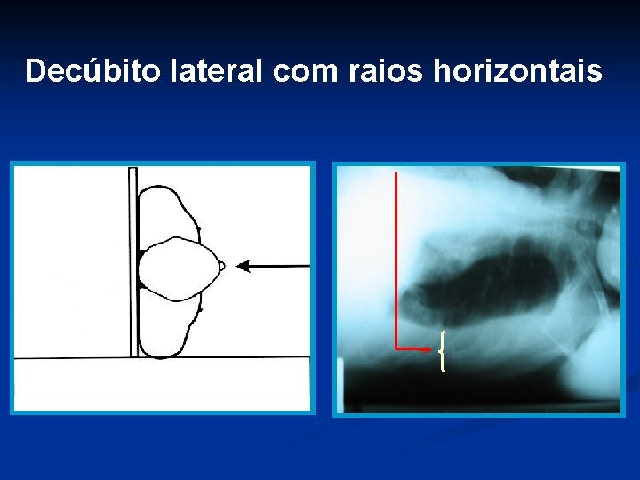 Decúbito lateral com raios horizontais 