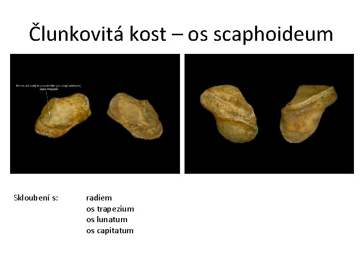 Člunkovitá kost – os scaphoideum Skloubení s: radiem os trapezium os lunatum os capitatum