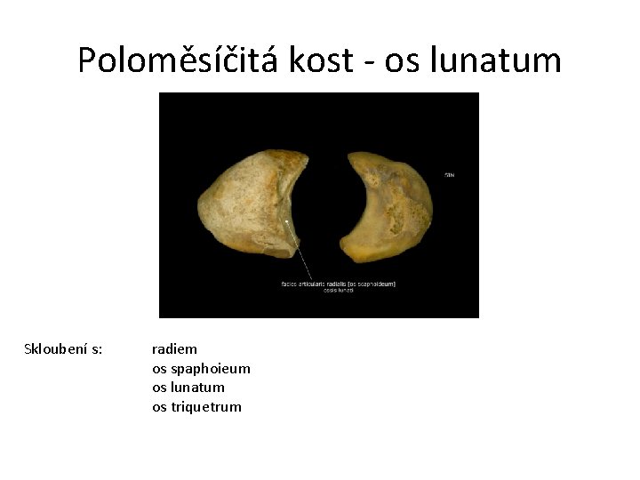 Poloměsíčitá kost - os lunatum Skloubení s: radiem os spaphoieum os lunatum os triquetrum