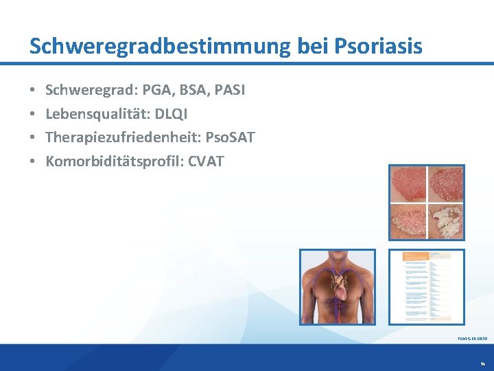 Schweregradbestimmung bei Psoriasis • • Schweregrad: PGA, BSA, PASI Lebensqualität: DLQI Therapiezufriedenheit: Pso. SAT