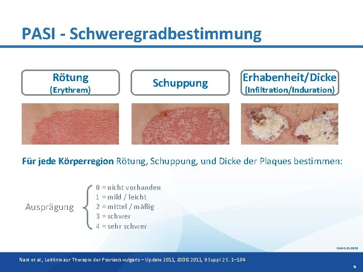 PASI - Schweregradbestimmung Rötung (Erythrem) Schuppung Erhabenheit/Dicke (Infiltration/Induration) Für jede Körperregion Rötung, Schuppung, und