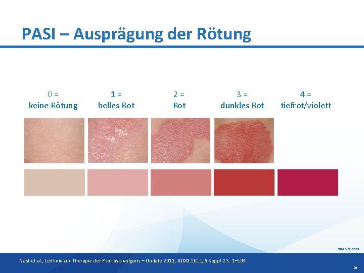 PASI – Ausprägung der Rötung 0= keine Rötung 1= helles Rot 2= Rot 3=