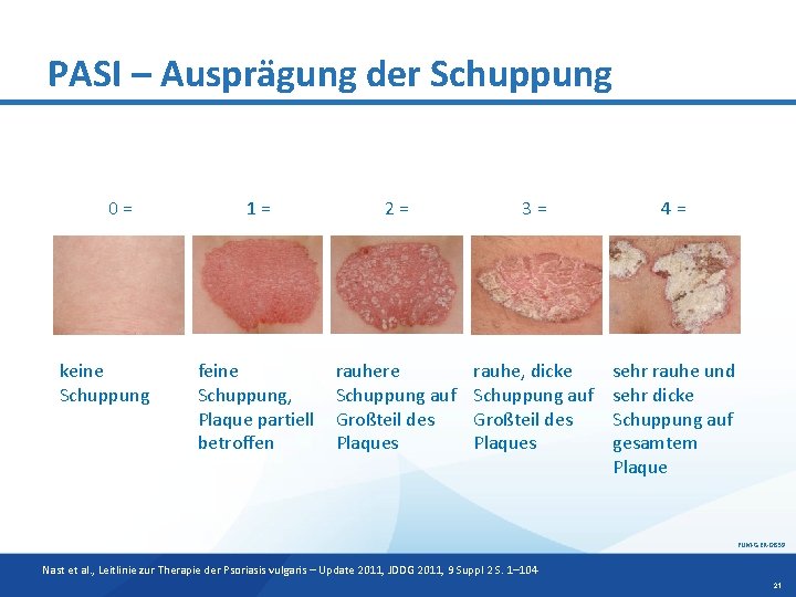 PASI – Ausprägung der Schuppung 0= keine Schuppung 1= 2= 3= 4= feine Schuppung,