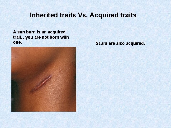 Inherited traits Vs. Acquired traits A sun burn is an acquired trait…you are not