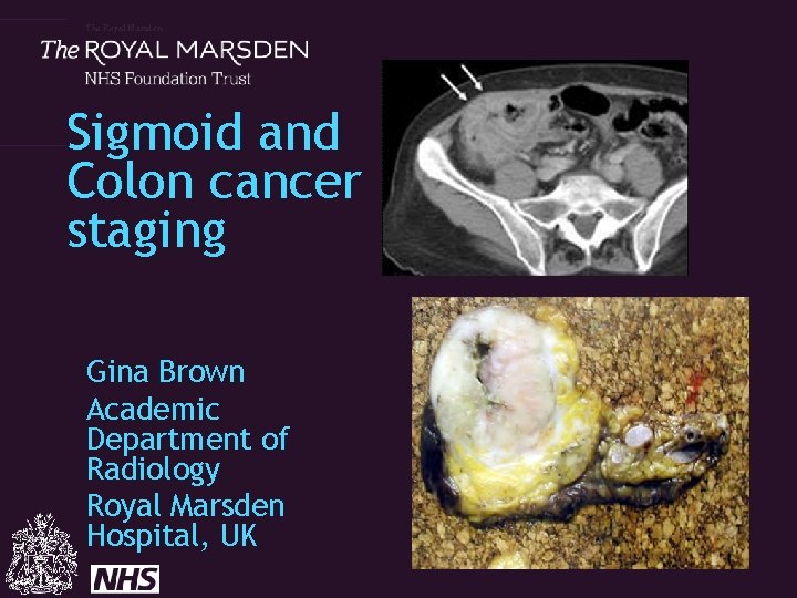 The Royal Marsden Sigmoid and Colon cancer staging Gina Brown Academic Department of Radiology