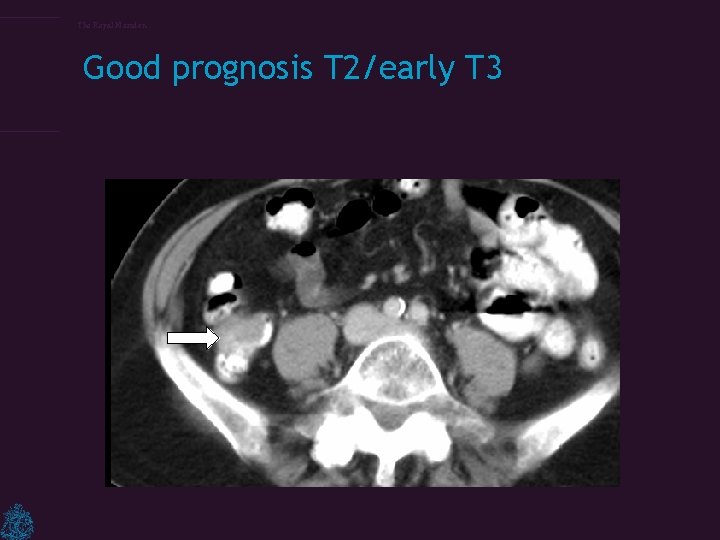 The Royal Marsden Good prognosis T 2/early T 3 