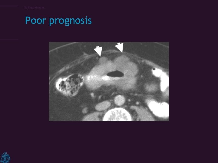 The Royal Marsden Poor prognosis 