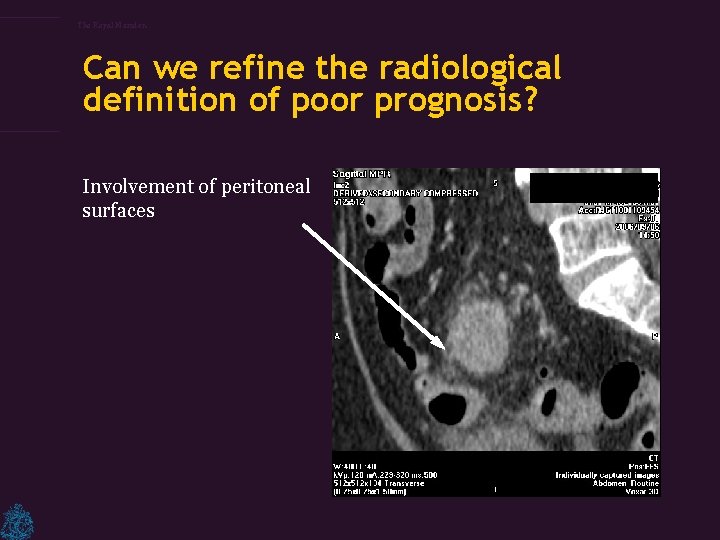 The Royal Marsden Can we refine the radiological definition of poor prognosis? Involvement of