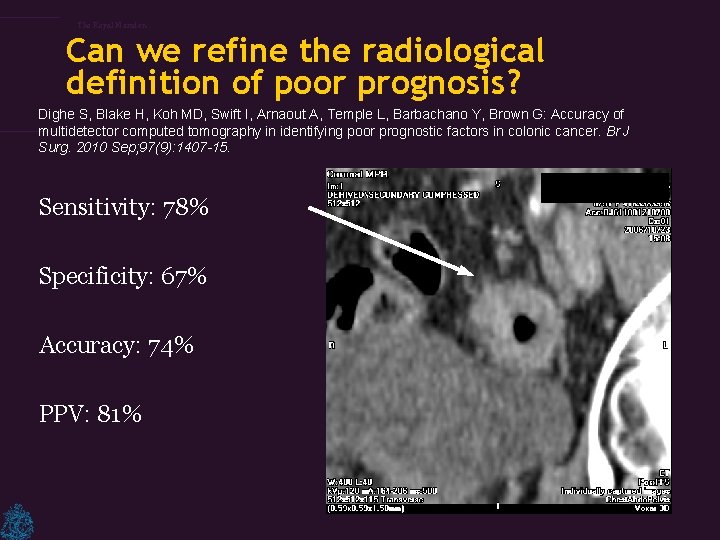 The Royal Marsden Can we refine the radiological definition of poor prognosis? Dighe S,
