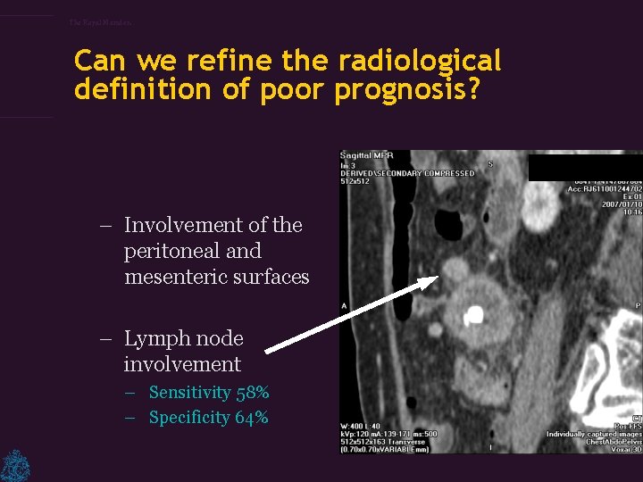 The Royal Marsden Can we refine the radiological definition of poor prognosis? – Involvement
