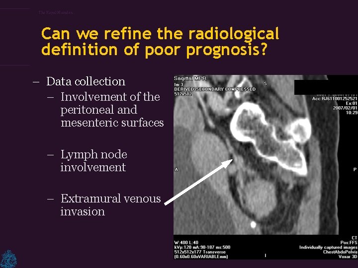 The Royal Marsden Can we refine the radiological definition of poor prognosis? – Data