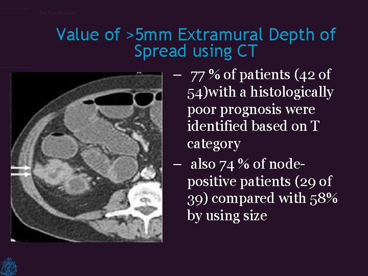 The Royal Marsden Value of >5 mm Extramural Depth of Spread using CT –
