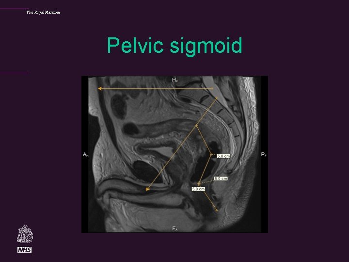 The Royal Marsden Pelvic sigmoid 