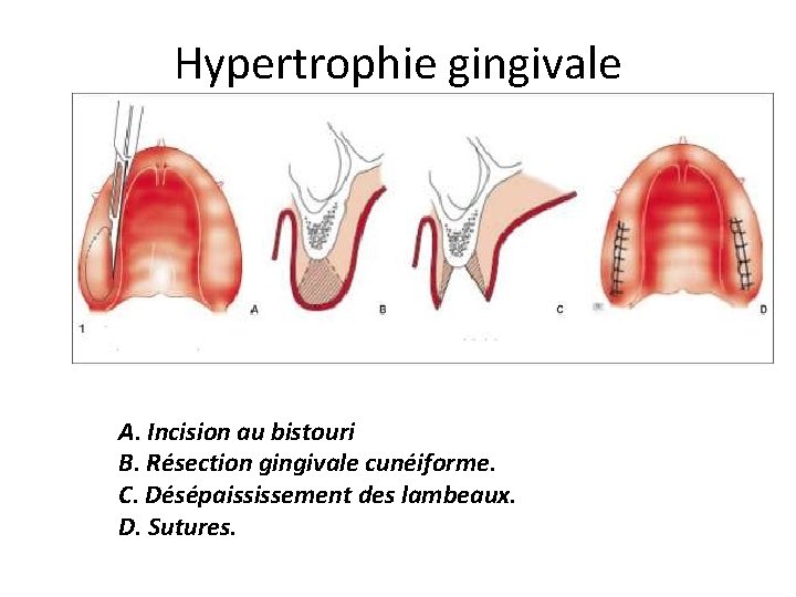 Hypertrophie gingivale A. Incision au bistouri B. Résection gingivale cunéiforme. C. Désépaississement des lambeaux.