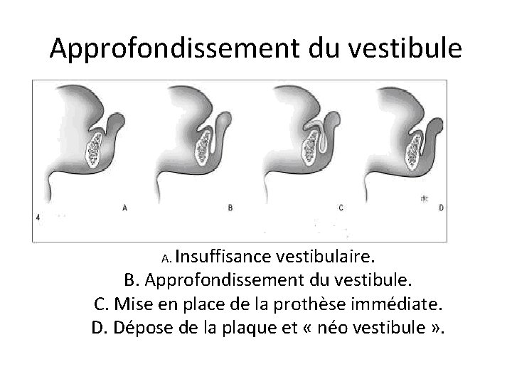 Approfondissement du vestibule A. Insuffisance vestibulaire. B. Approfondissement du vestibule. C. Mise en place