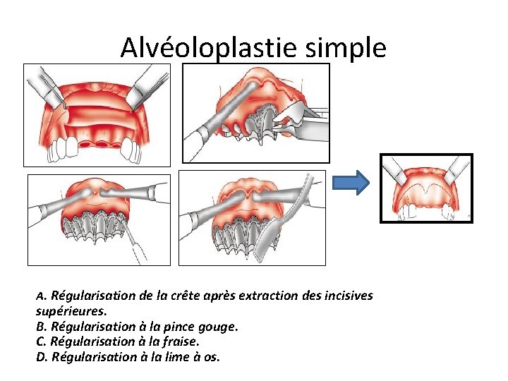 Alvéoloplastie simple A. Régularisation de la crête après extraction des incisives supérieures. B. Régularisation