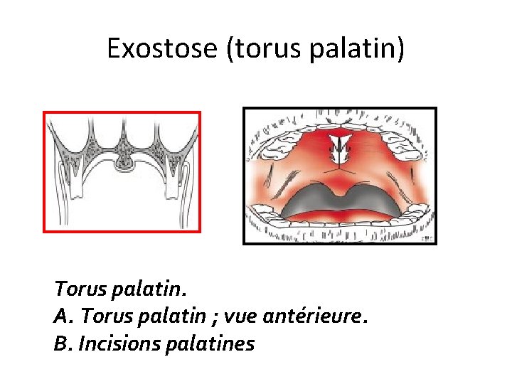 Exostose (torus palatin) Torus palatin. A. Torus palatin ; vue antérieure. B. Incisions palatines