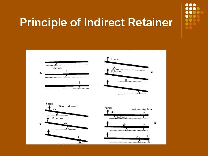 Principle of Indirect Retainer 