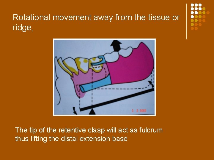 Rotational movement away from the tissue or ridge, The tip of the retentive clasp