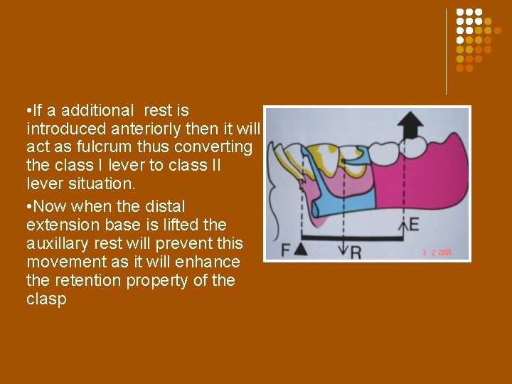  • If a additional rest is introduced anteriorly then it will act as