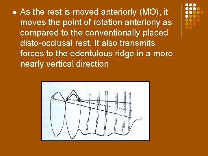 l As the rest is moved anteriorly (MO), it moves the point of rotation