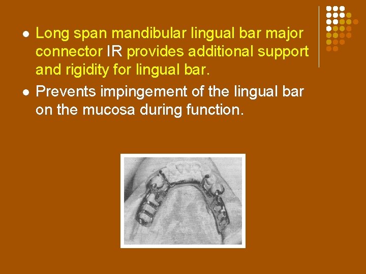 l l Long span mandibular lingual bar major connector IR provides additional support and