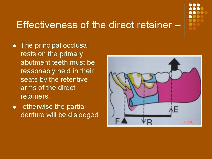 Effectiveness of the direct retainer – l l The principal occlusal rests on the