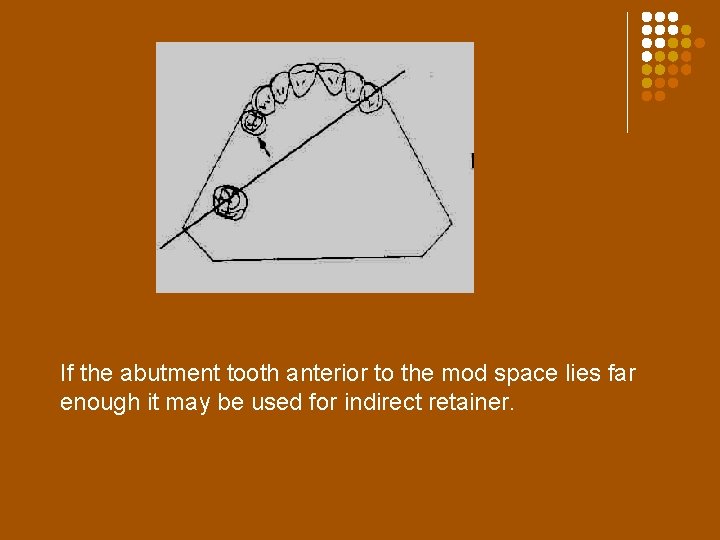 If the abutment tooth anterior to the mod space lies far enough it may