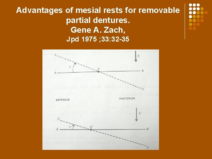 Advantages of mesial rests for removable partial dentures. Gene A. Zach, Jpd 1975 ;