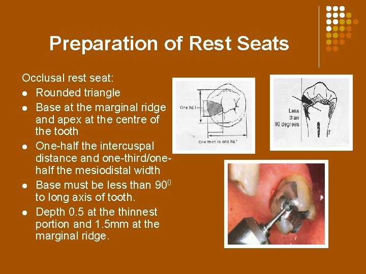 Preparation of Rest Seats Occlusal rest seat: l Rounded triangle l Base at the