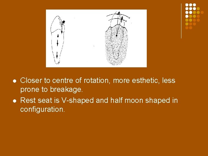 l l Closer to centre of rotation, more esthetic, less prone to breakage. Rest