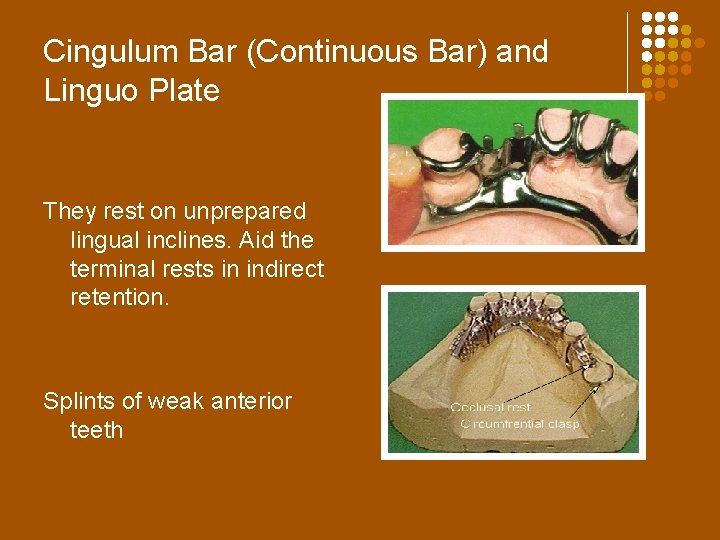 Cingulum Bar (Continuous Bar) and Linguo Plate They rest on unprepared lingual inclines. Aid