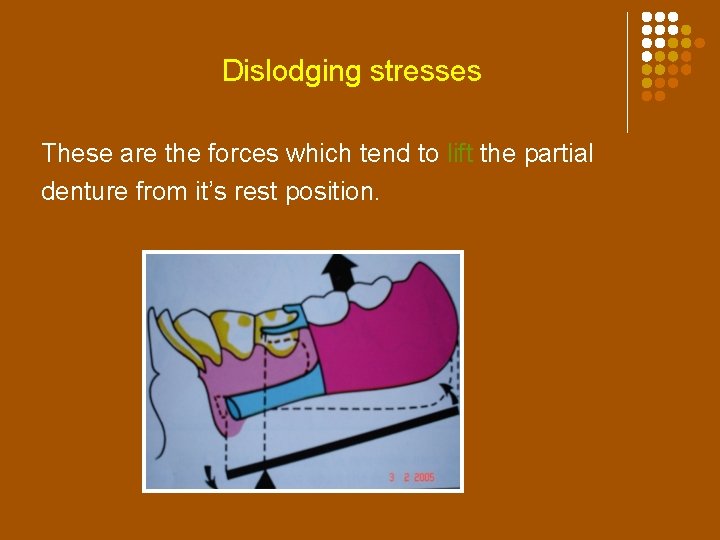 Dislodging stresses : These are the forces which tend to lift the partial denture