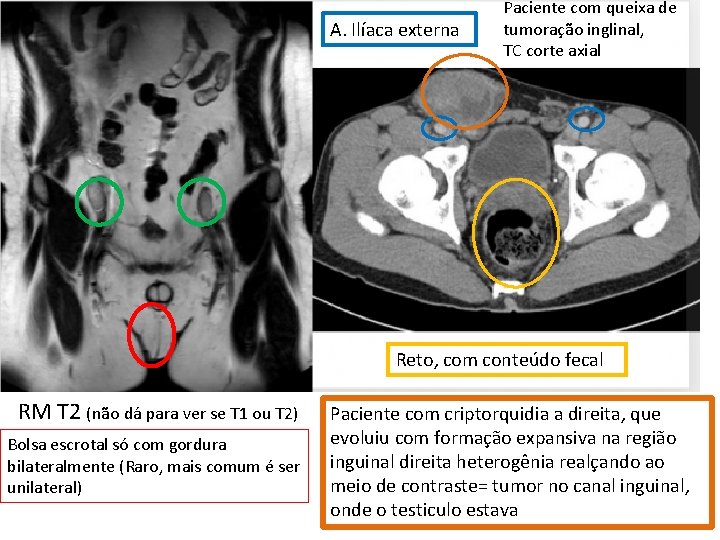 A. Ilíaca externa Paciente com queixa de tumoração inglinal, TC corte axial Reto, com