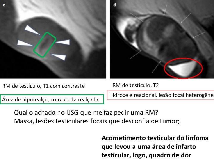 RM de testículo, T 1 com contraste Área de hiporealçe, com borda realçada RM