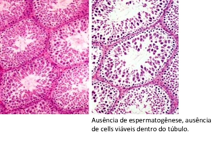 Ausência de espermatogênese, ausência de cells viáveis dentro do túbulo. 