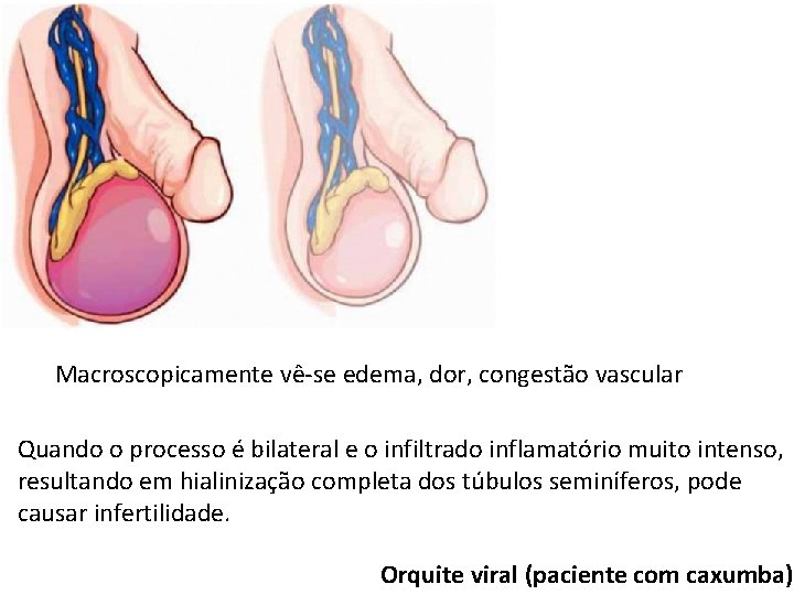 Macroscopicamente vê-se edema, dor, congestão vascular Quando o processo é bilateral e o infiltrado