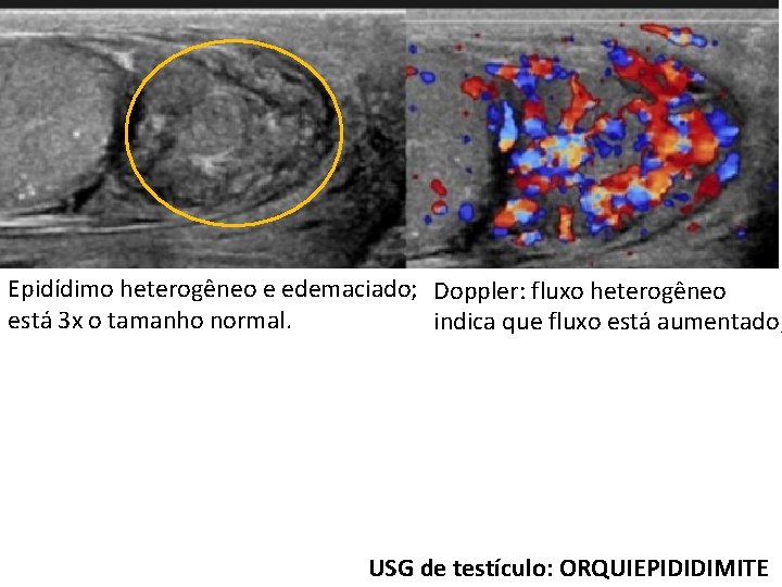 Epidídimo heterogêneo e edemaciado; Doppler: fluxo heterogêneo está 3 x o tamanho normal. indica