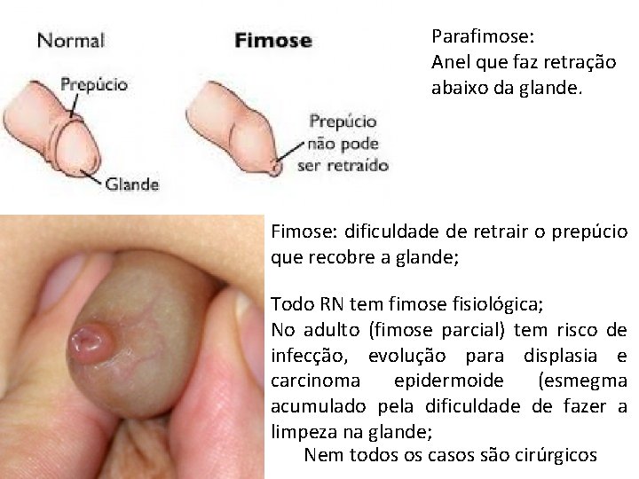 Parafimose: Anel que faz retração abaixo da glande. Fimose: dificuldade de retrair o prepúcio