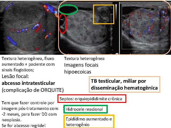 Textura heterogênea, fluxo aumentado + paciente com sinais flogisticos; Textura heterogênea Lesão focal: abcesso