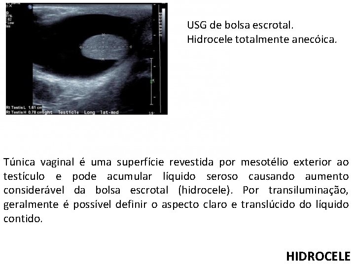 USG de bolsa escrotal. Hidrocele totalmente anecóica. Túnica vaginal é uma superfície revestida por