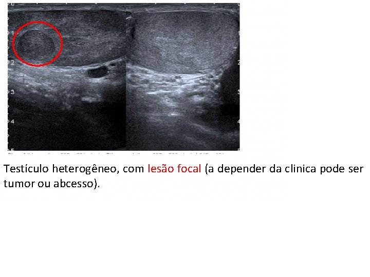 Testículo heterogêneo, com lesão focal (a depender da clinica pode ser tumor ou abcesso).