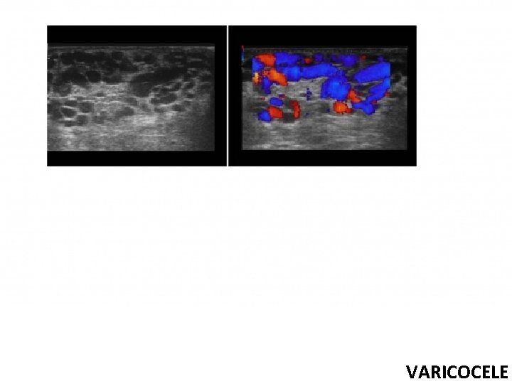 VARICOCELE 